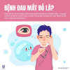 đau mắt đỏ