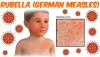 Bệnh rubella: Nguyên nhân, triệu chứng, biến chứng và cách đề phòng